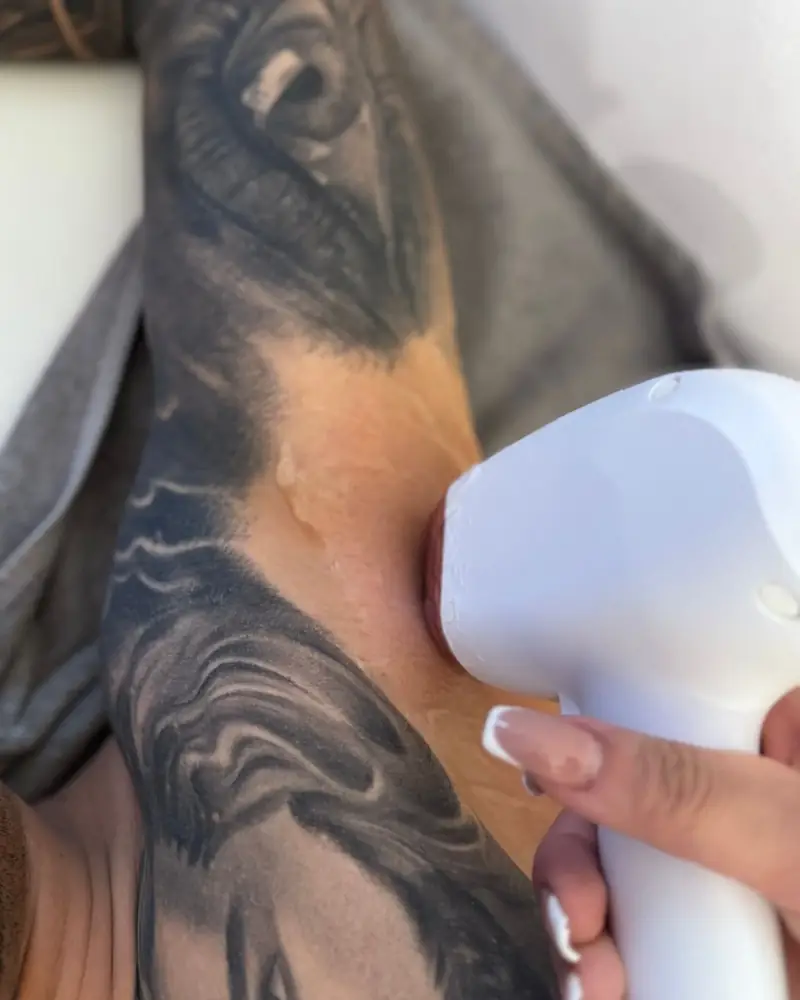 Laser hair removal